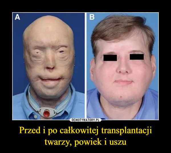 Przed i po całkowitej transplantacji twarzy, powiek i uszu