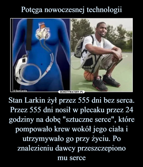 Stan Larkin żył przez 555 dni bez serca. Przez 555 dni nosił w plecaku przez 24 godziny na dobę "sztuczne serce", które pompowało krew wokół jego ciała i utrzymywało go przy życiu. Po znalezieniu dawcy przeszczepionomu serce –  